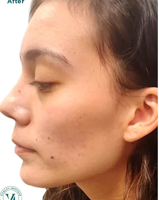 After treatment